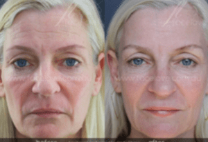 face fillers